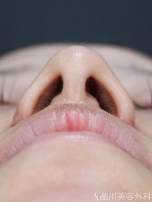 症例NO.72620のAFTER写真