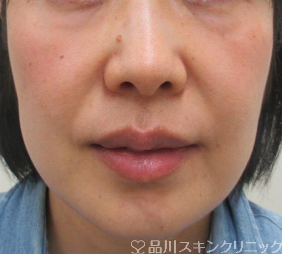 症例NO.25901のBEFORE写真
