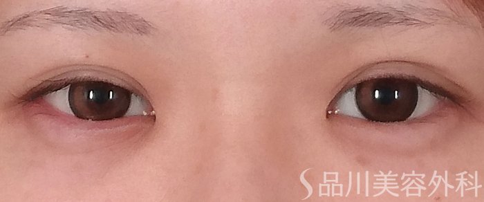 症例NO.69623のAFTER写真