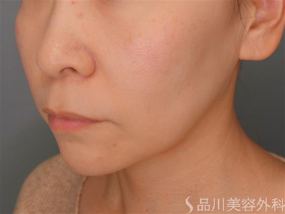 症例NO.53287のBEFORE写真