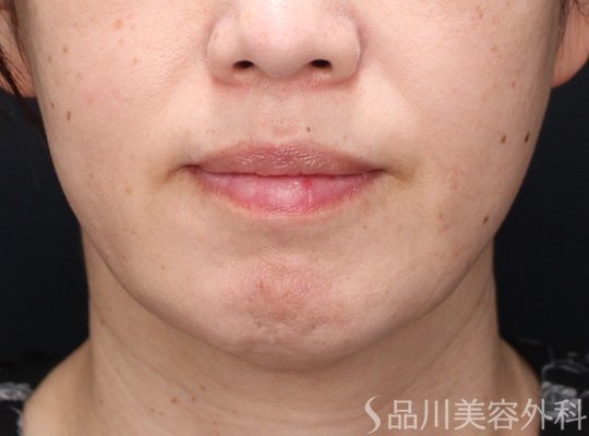 症例NO.72228のAFTER写真