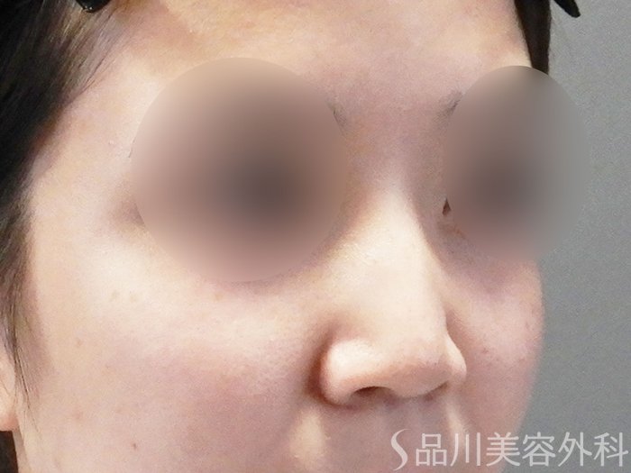 症例NO.72231のBEFORE写真