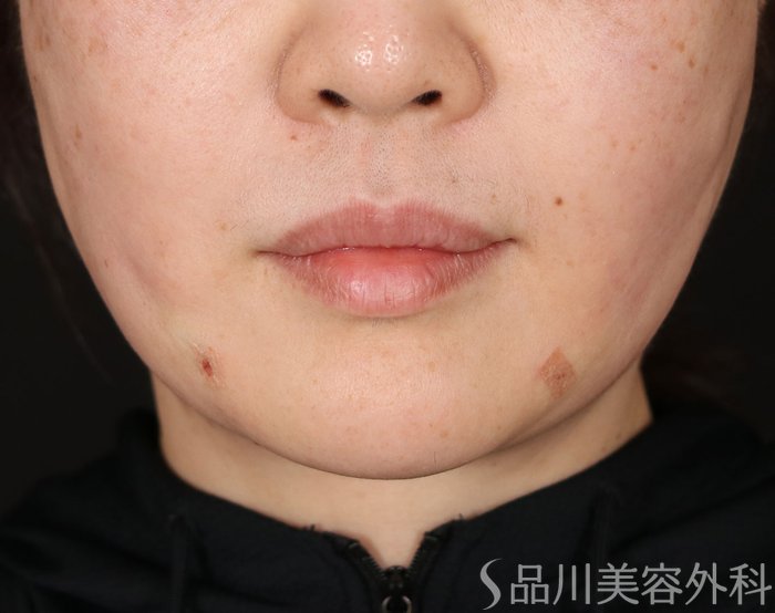 症例NO.71792のAFTER写真