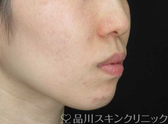 症例NO.67630のBEFORE写真