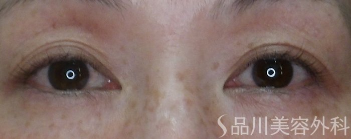 症例NO.69210のBEFORE写真