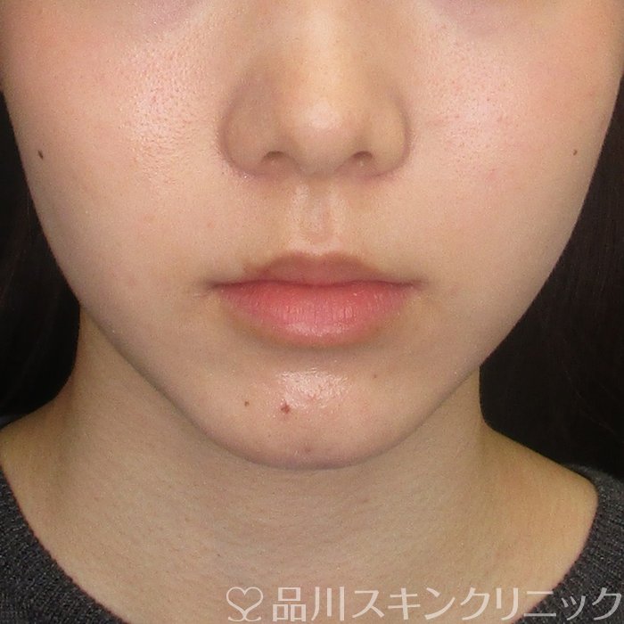 症例NO.73275のAFTER写真