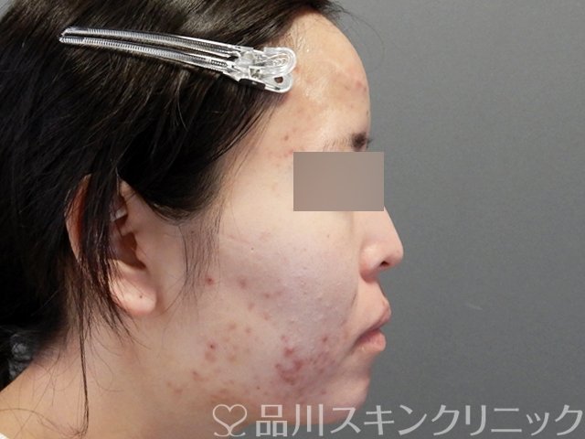 症例NO.71632のBEFORE写真