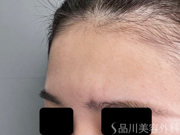 症例NO.70502のBEFORE写真