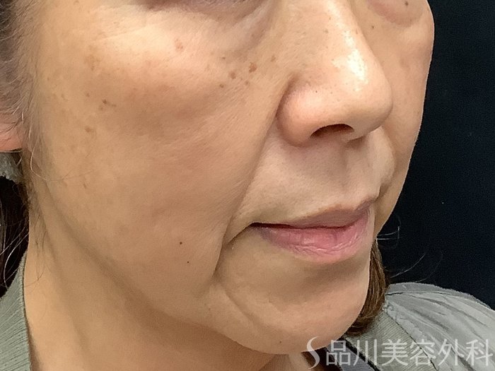 症例NO.68056のBEFORE写真