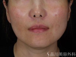 症例NO.71375のBEFORE写真