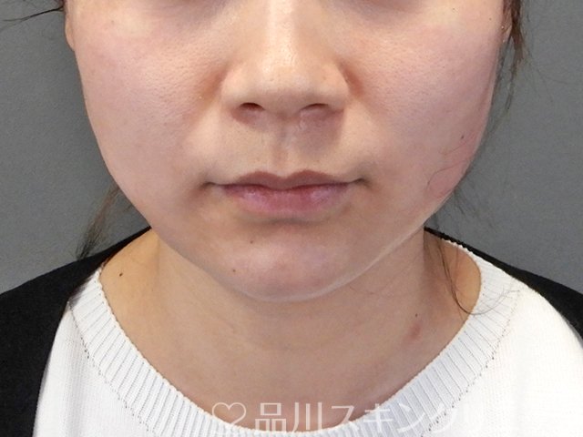 症例NO.64503のAFTER写真