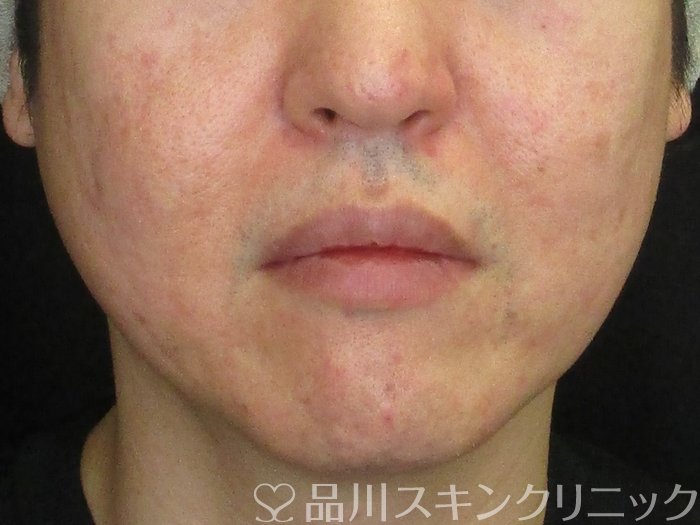 症例NO.73263のAFTER写真