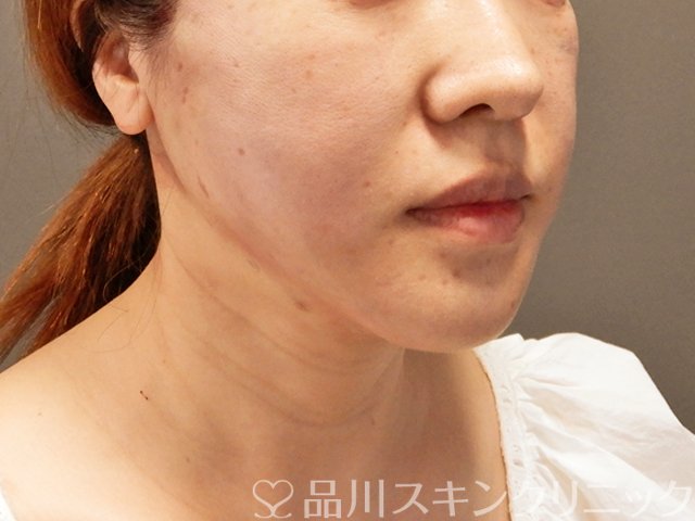 症例NO.70932のAFTER写真