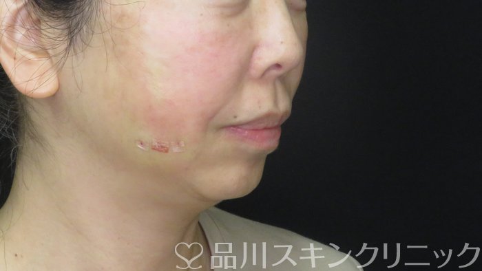 症例NO.72428のAFTER写真