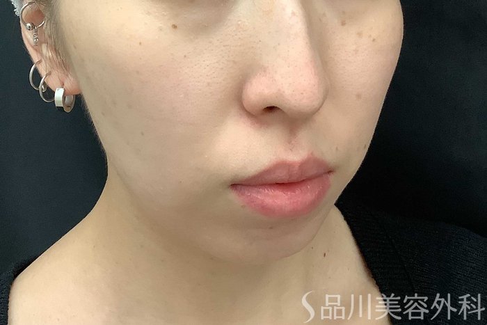 症例NO.69775のAFTER写真