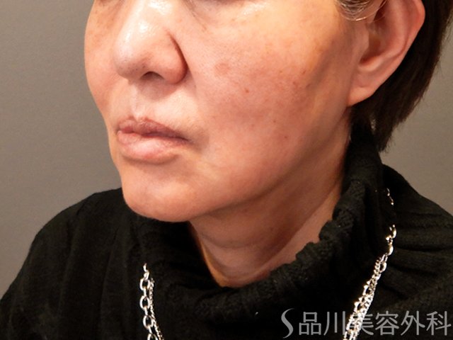 症例NO.69681のAFTER写真