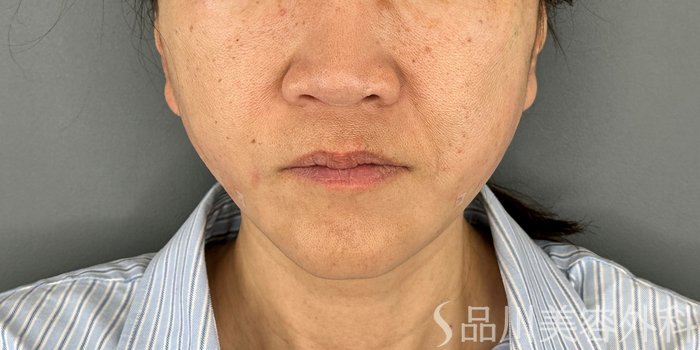 症例NO.70176のAFTER写真