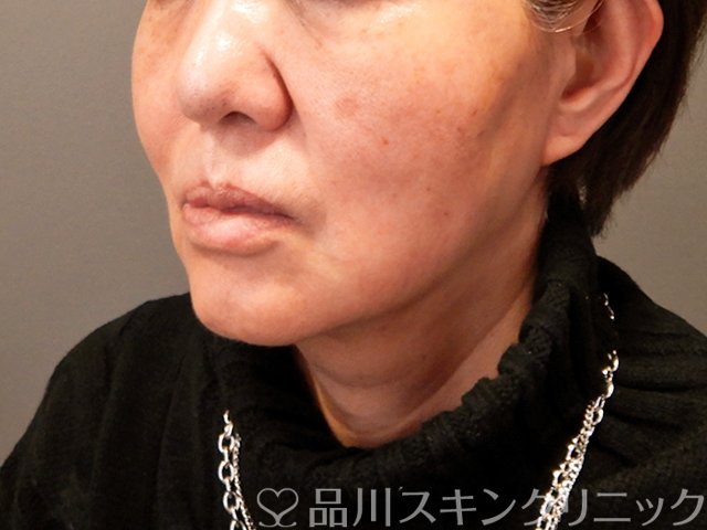症例NO.69681のAFTER写真