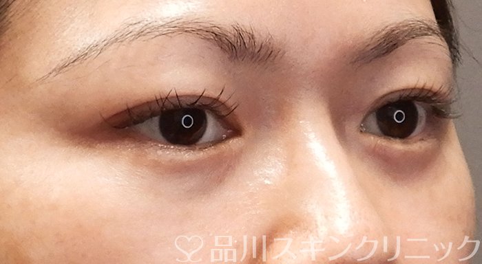 症例NO.69558のBEFORE写真