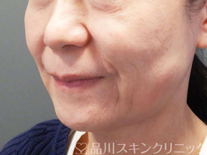 症例NO.73699のBEFORE写真