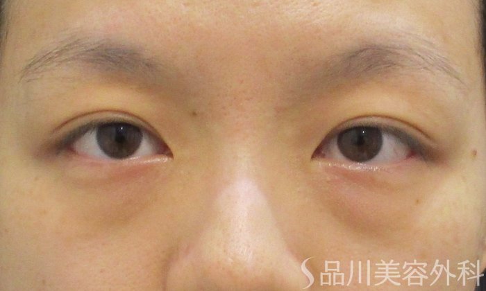 症例NO.71894のBEFORE写真