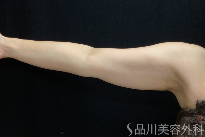 症例NO.69545のBEFORE写真