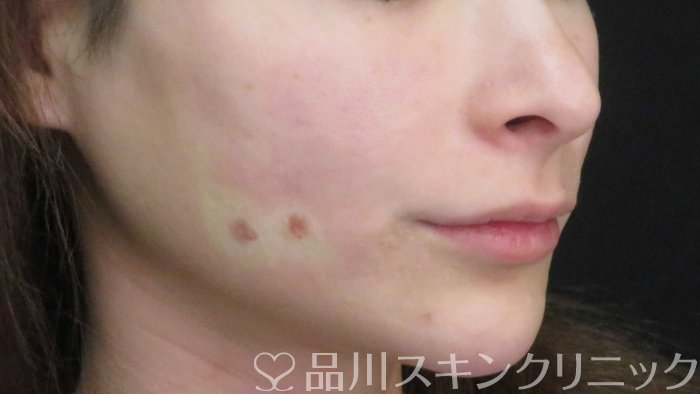 症例NO.71198のAFTER写真