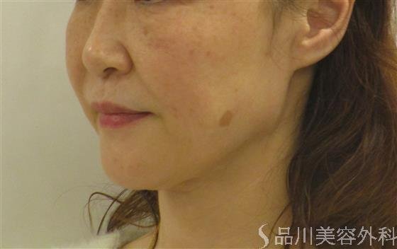 症例NO.58656のBEFORE写真