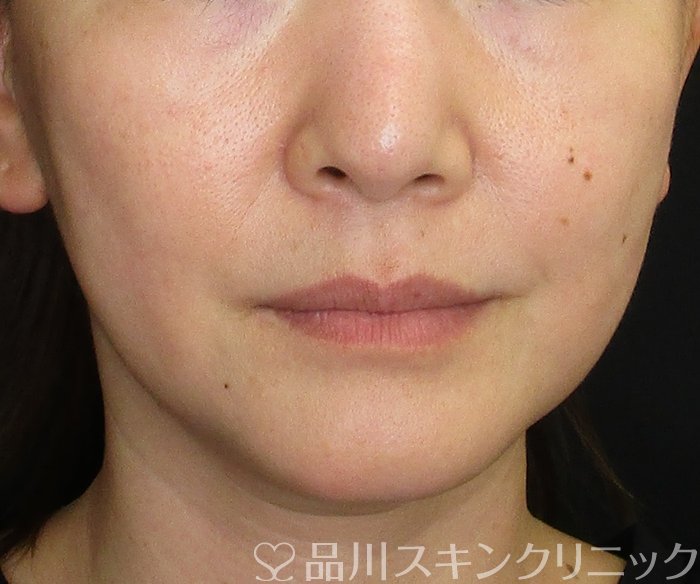 症例NO.74890のBEFORE写真