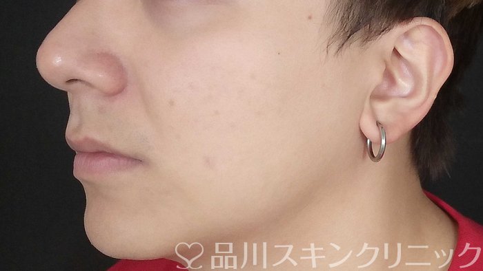 症例NO.71366のBEFORE写真