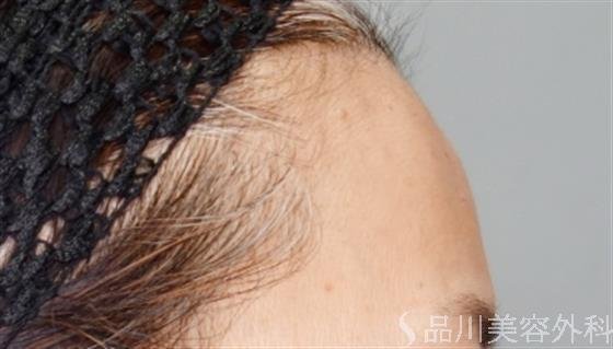 症例NO.53040のBEFORE写真