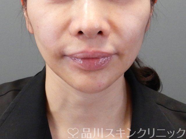 症例NO.68057のBEFORE写真