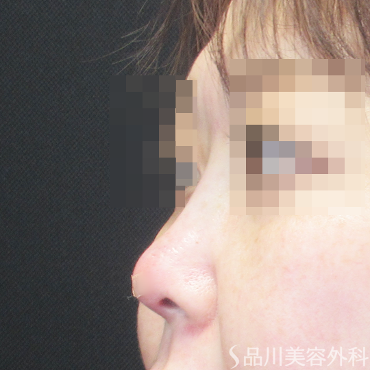 症例NO.69612のAFTER写真