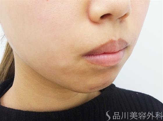 症例NO.40864のBEFORE写真