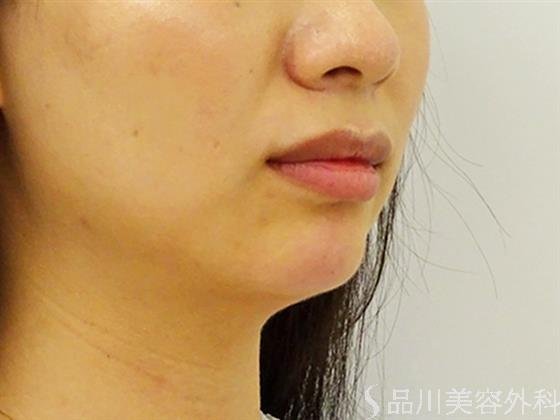 症例NO.53080のAFTER写真