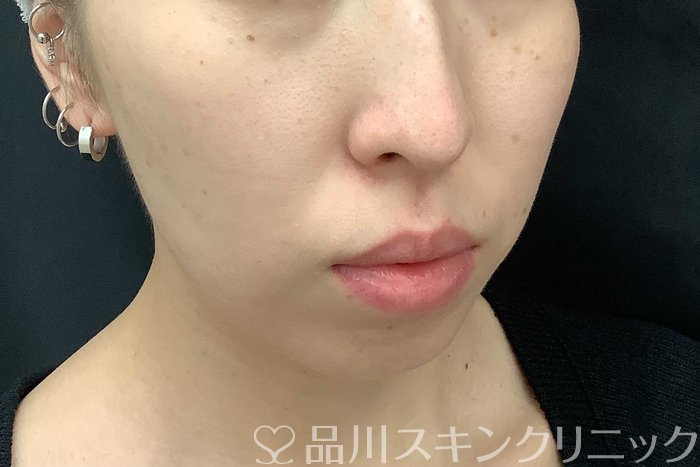 症例NO.69775のAFTER写真