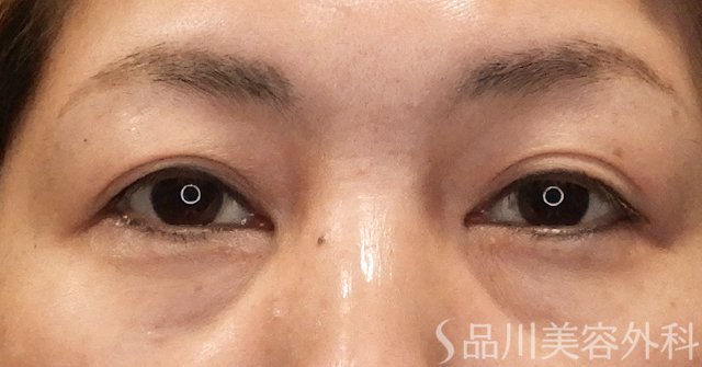 症例NO.72127のBEFORE写真