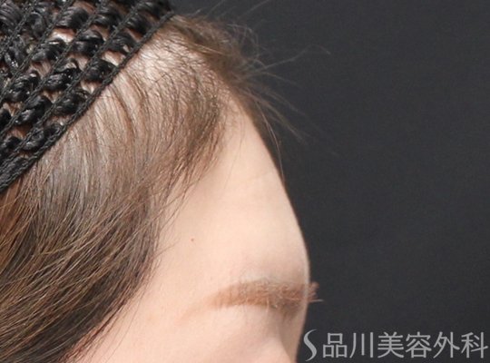 症例NO.73811のBEFORE写真