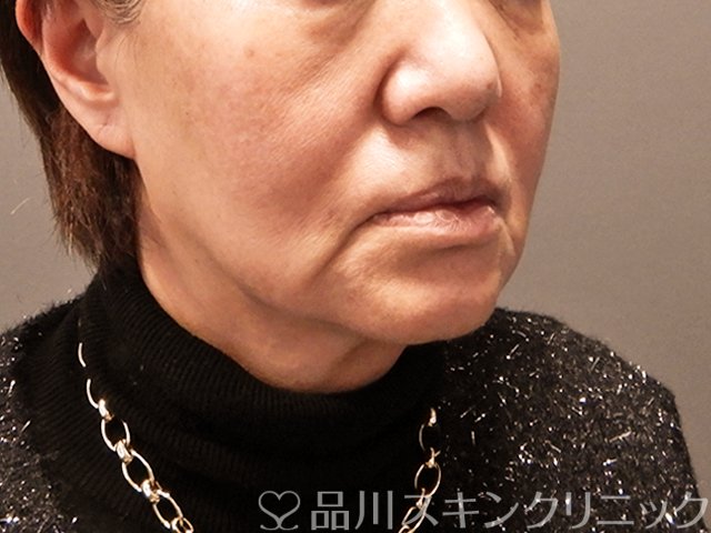 症例NO.69681のBEFORE写真