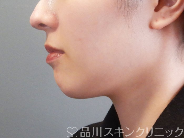 症例NO.72980のBEFORE写真