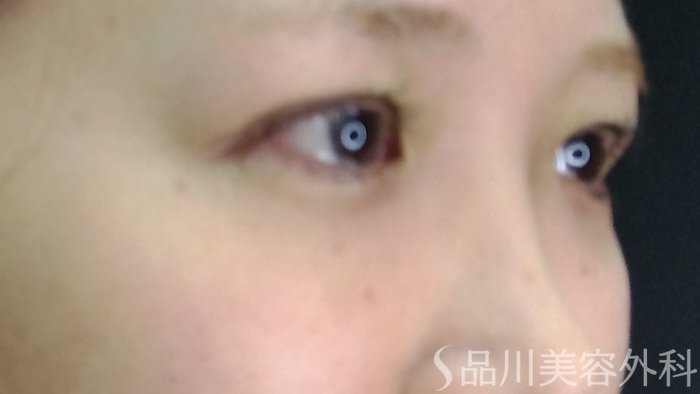 症例NO.71261のAFTER写真