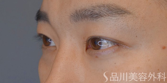 症例NO.74204のAFTER写真
