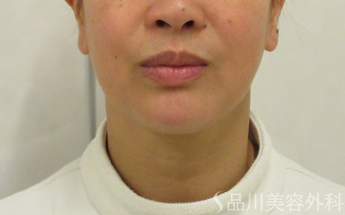 症例NO.72375のBEFORE写真