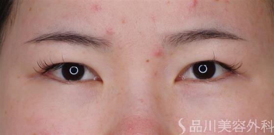 症例NO.48600のBEFORE写真