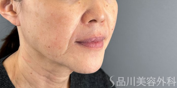 症例NO.73141のBEFORE写真