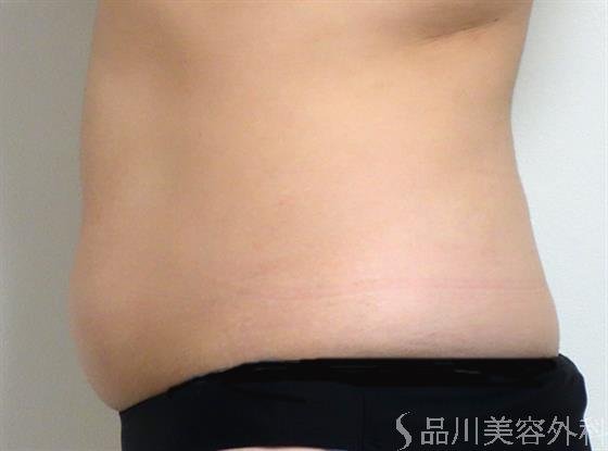 症例NO.35165のBEFORE写真