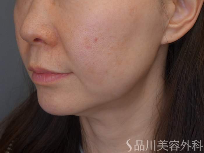 症例NO.69278のBEFORE写真