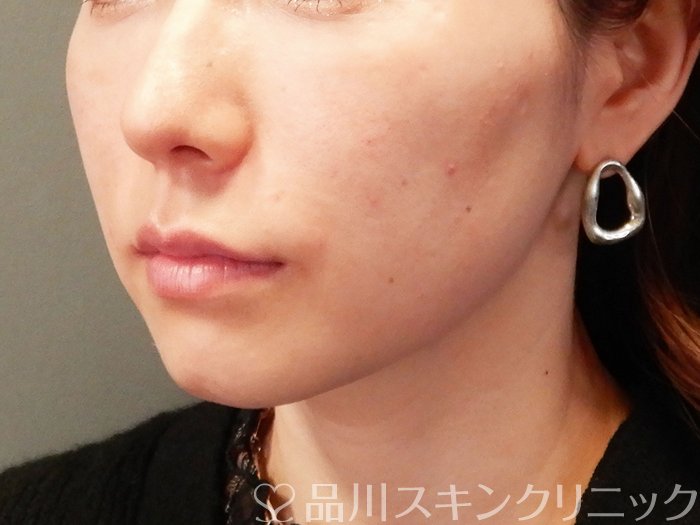 症例NO.62409のAFTER写真