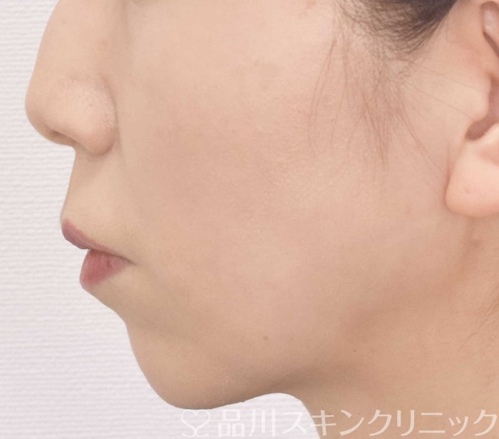 症例NO.72316のAFTER写真