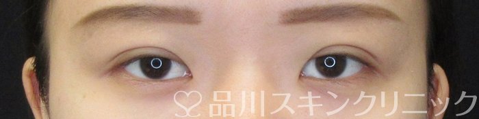 症例NO.64990のAFTER写真